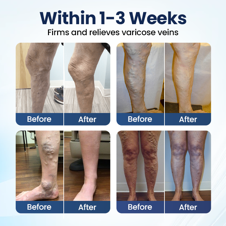LUMIVO® Deep Vein Repair Microneedle Patch