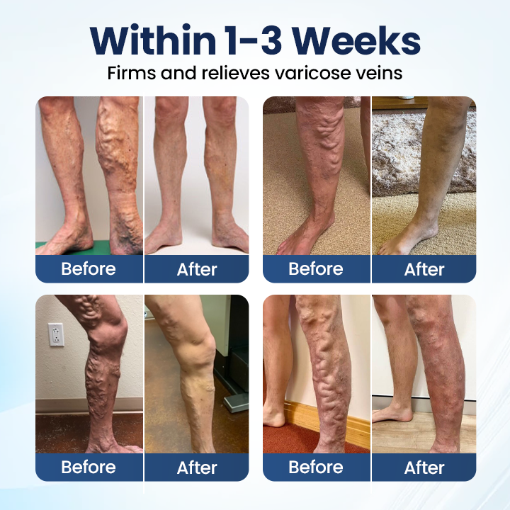 LUMIVO® Deep Vein Repair Microneedle Patch