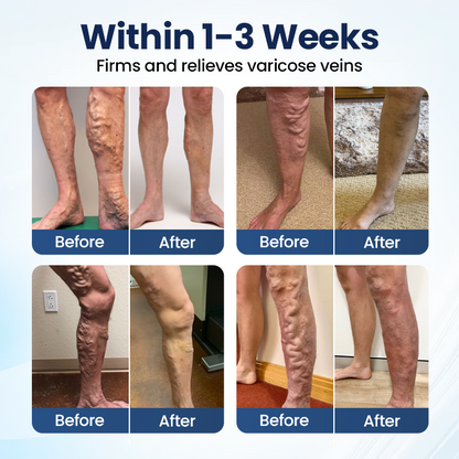 LUMIVO® Deep Vein Repair Microneedle Patch