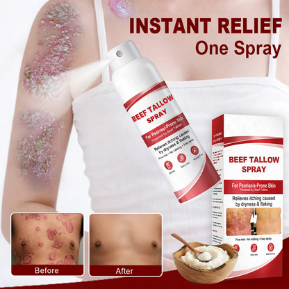 Beef Tallow Spray for Itchy, Flaky Psoriasis Skin