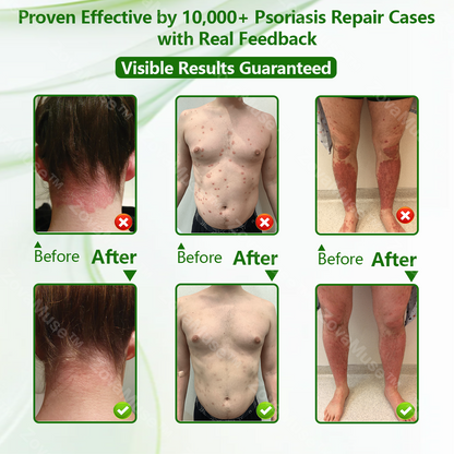Herbal Miracle Cream for Stubborn Skin Issues