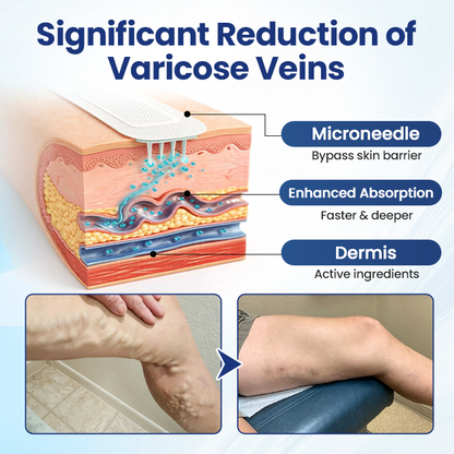 LUMIVO® Deep Vein Repair Microneedle Patch