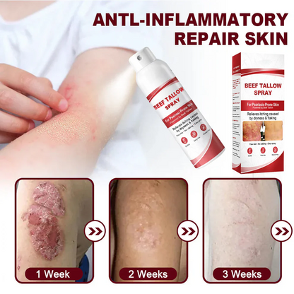 Beef Tallow Spray for Itchy, Flaky Psoriasis Skin