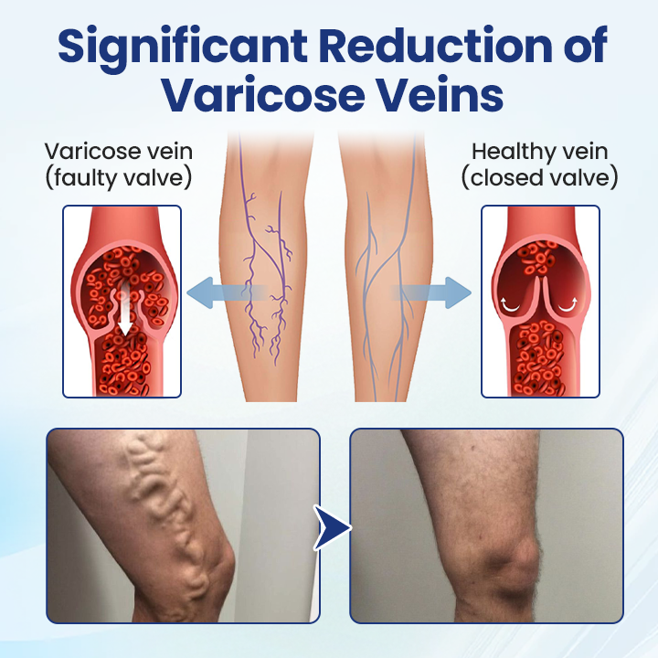 LUMIVO® Deep Vein Repair Microneedle Patch