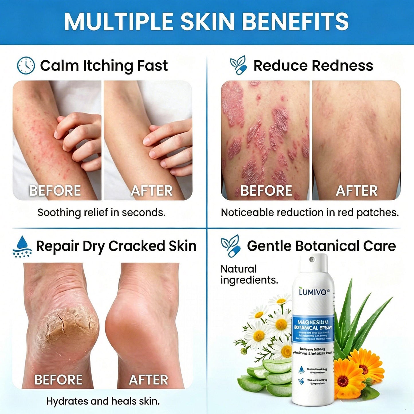 🔥LUMIVO® Magnesium Botanical Spray – Advanced Skin Recovery for Psoriasis & Eczema | Rapid Soothing, Steroid-Free