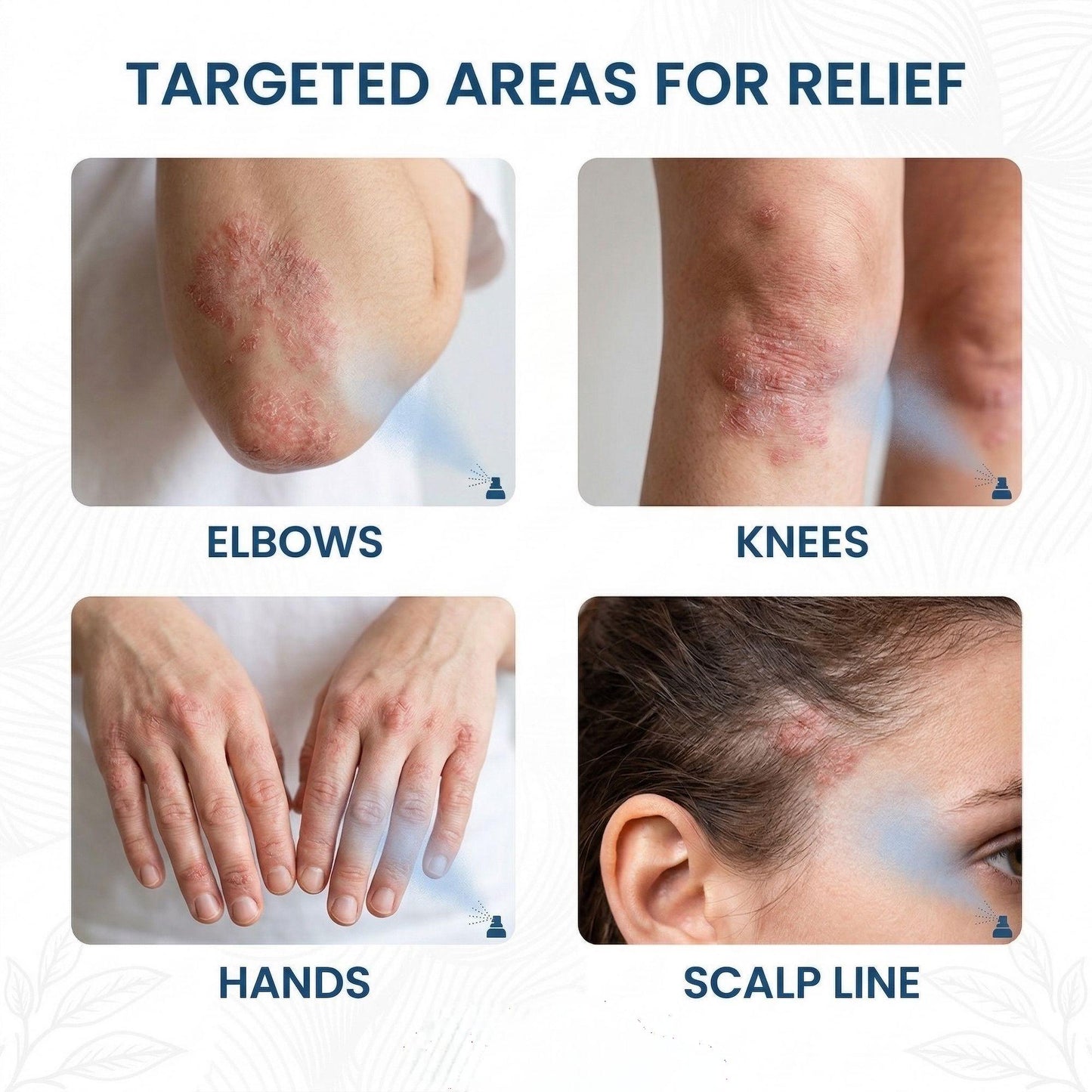 🔥LUMIVO® Magnesium Botanical Spray – Advanced Skin Recovery for Psoriasis & Eczema | Rapid Soothing, Steroid-Free